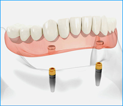 Implant Supported Denture