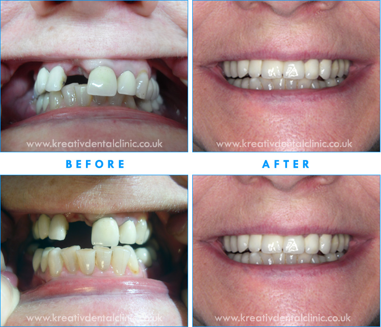 Crowns, and Bridge work at Kreativ Dental Clinic recommended dentist in Hungary